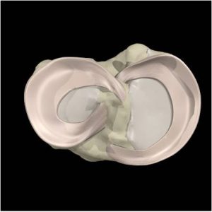 internal-meniscus