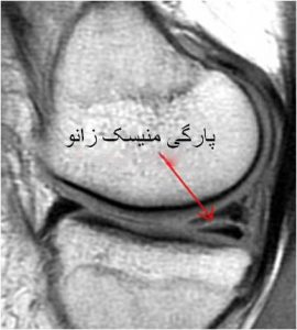 meniscus-mri