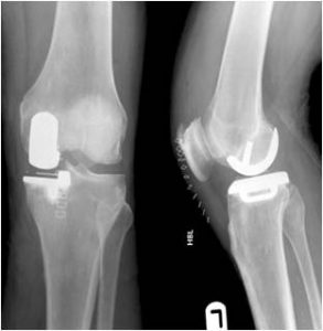 external-compartment-replacement