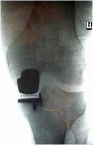tibial-plateau-fracture